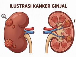 Mari berkenalan dengan Kanker Ginjal, “Sahabat 6 tahun” Vidi Aldiano